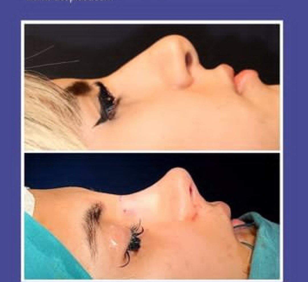 Dr Farzan Rezaee - Rhinoplasty in Iran