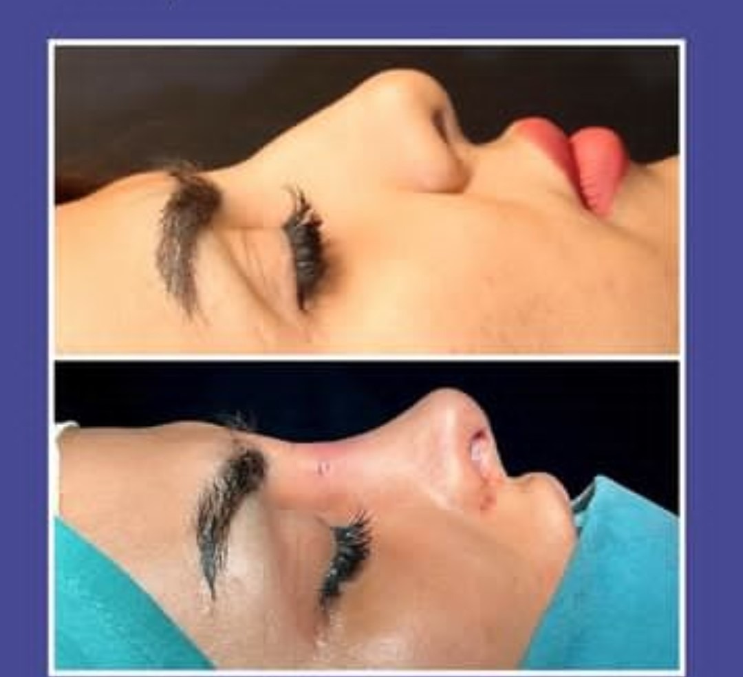 Dr Farzan Rezaee - Rhinoplasty in Iran