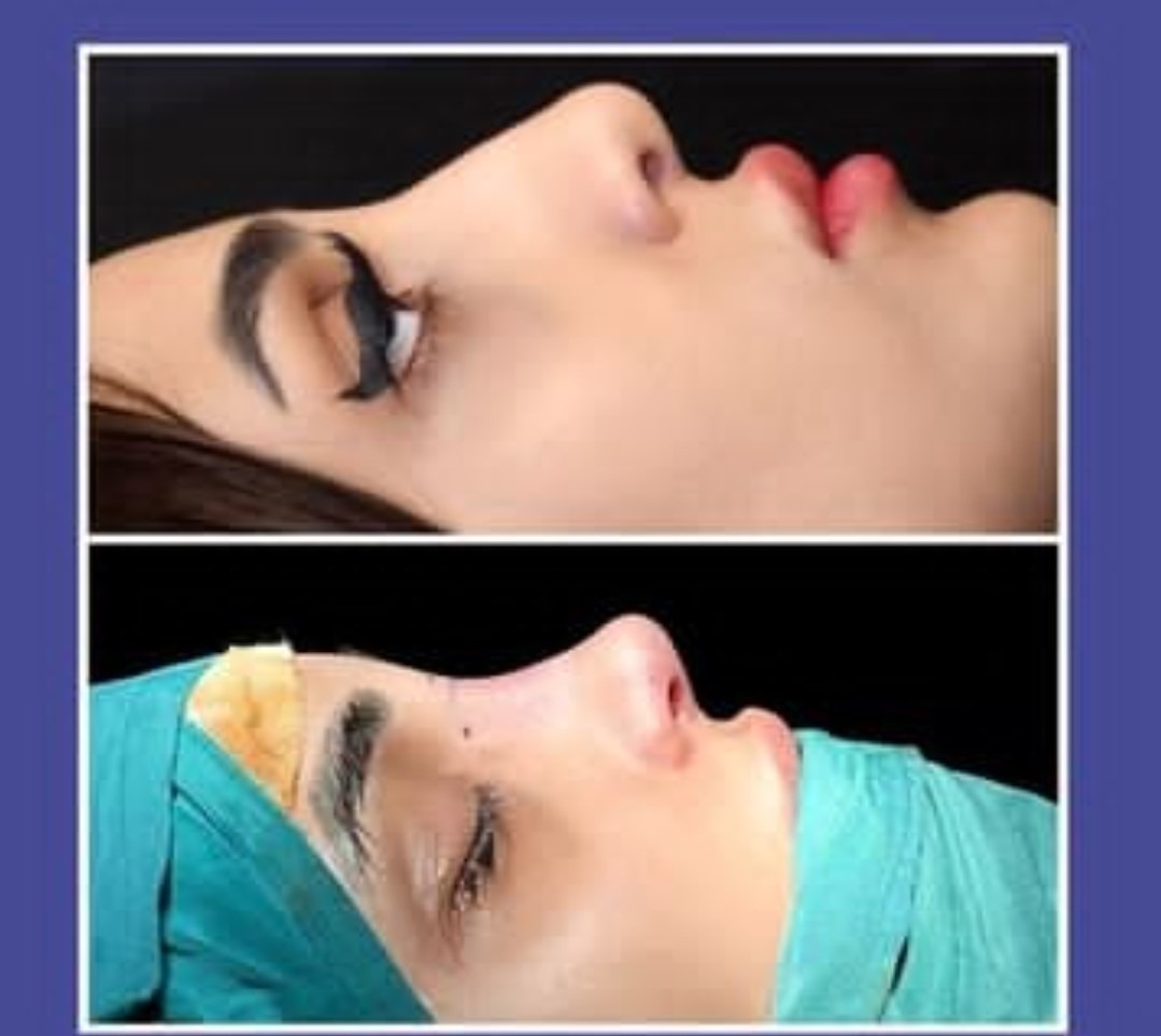 Dr Farzan Rezaee - Rhinoplasty in Iran