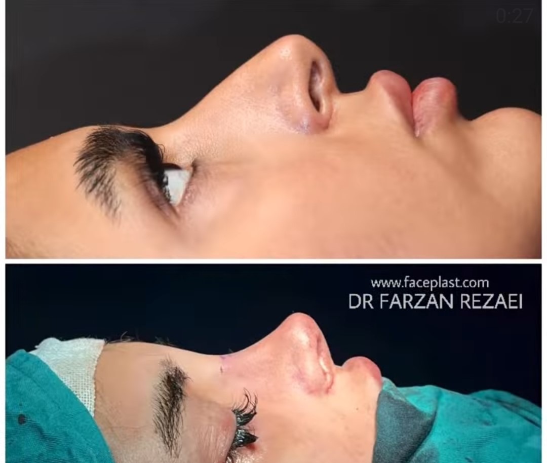 Dr Farzan Rezaee - Rhinoplasty in Iran