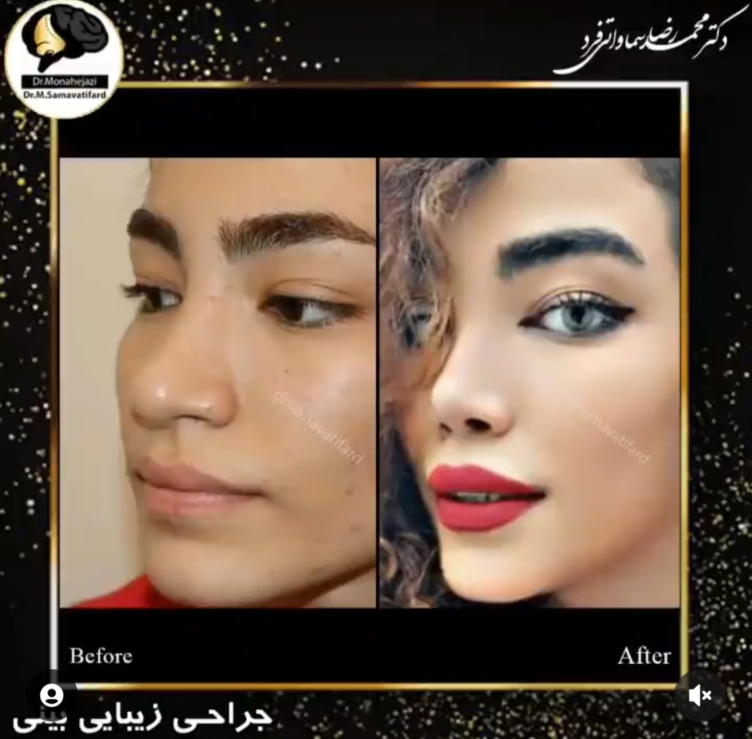 Dr Samavati - Nose job in Iran