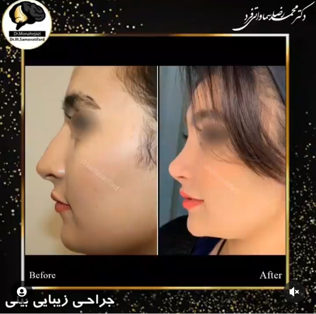Dr Samavati - Nose job in Iran