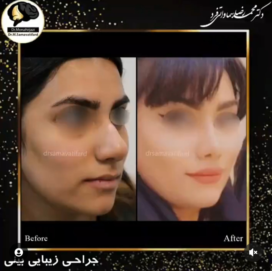 Dr Samavati - Nose job in Iran