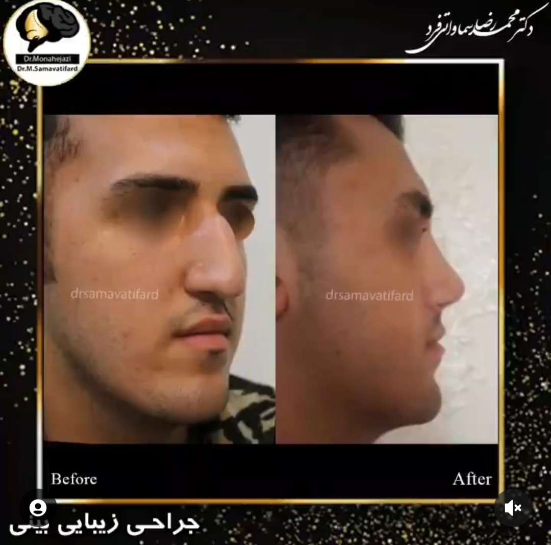 Dr Samavati - Nose job in Iran