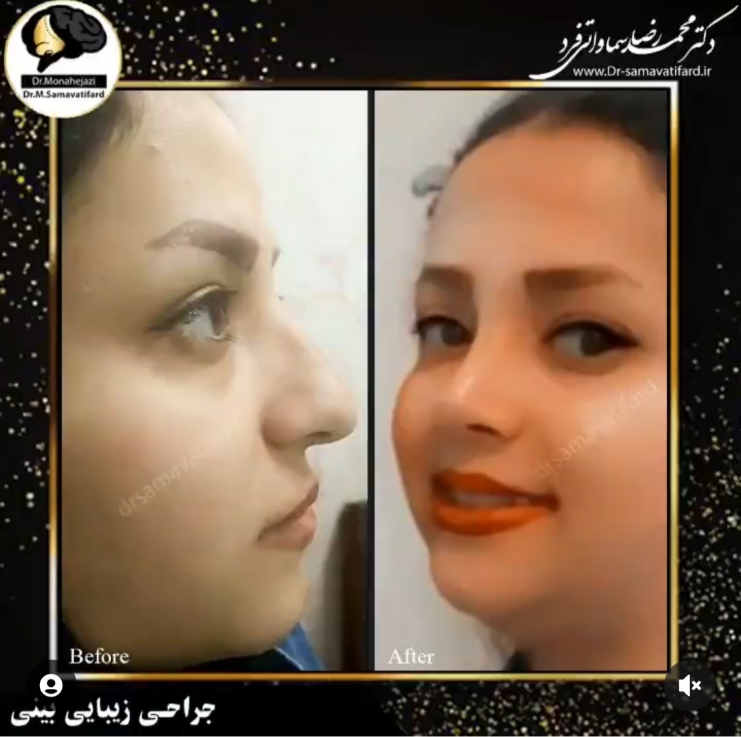 Dr Samavati - Rhinoplasty in Iran