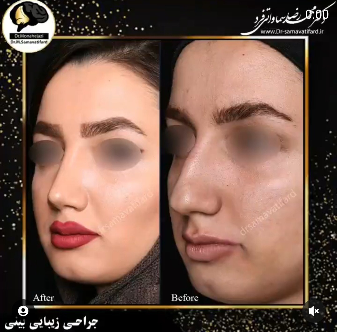 Dr Samavati - Rhinoplasty in Iran