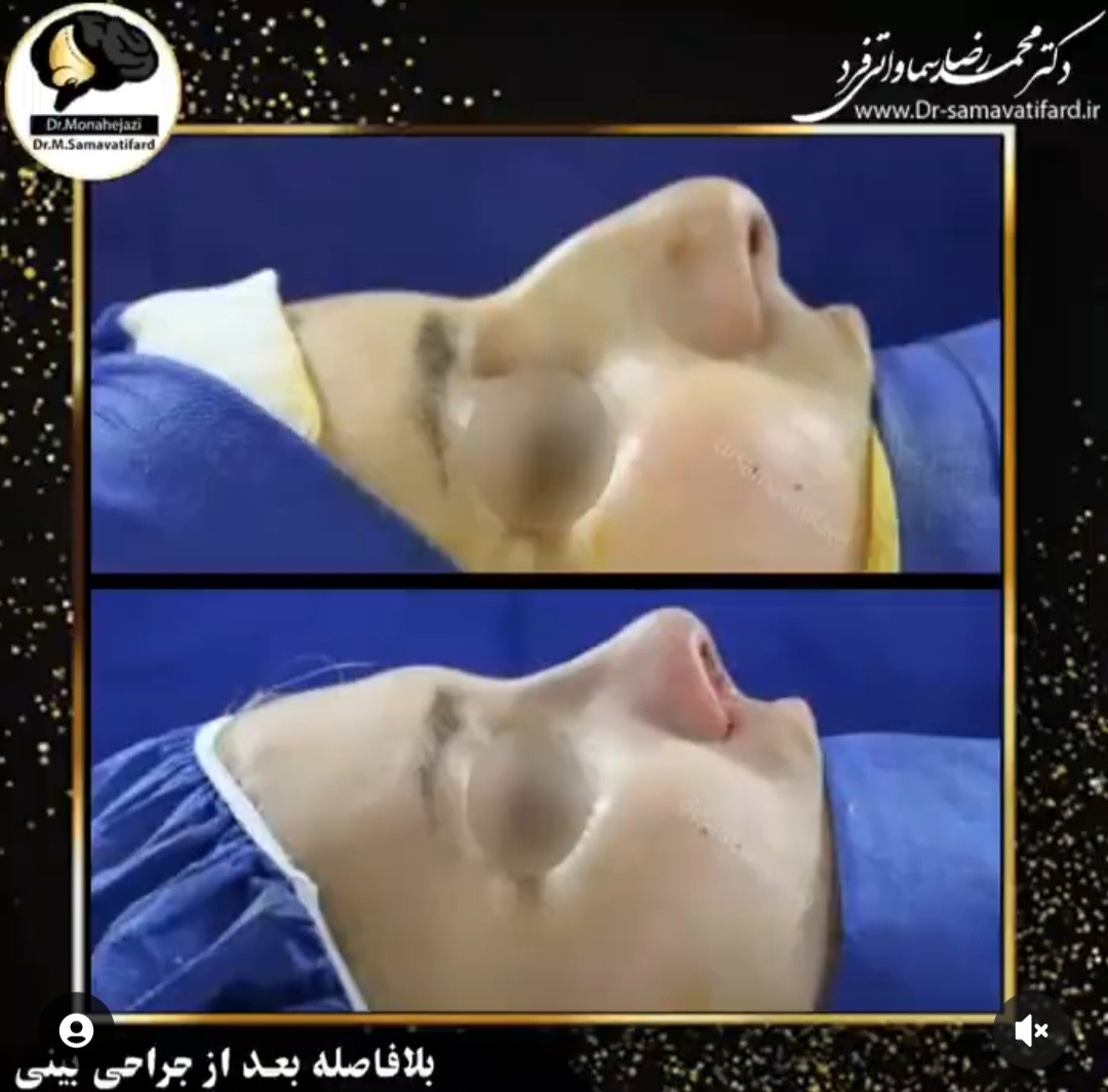 Dr Samavati - Rhinoplasty in Iran